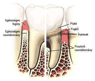 fogkőeltávolítás - fogkő és az ínygyulladás